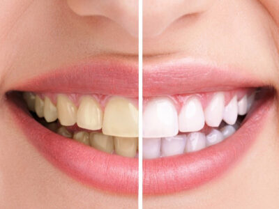 Kosmetische Zahnbleaching Schulung-Präsenzkurse